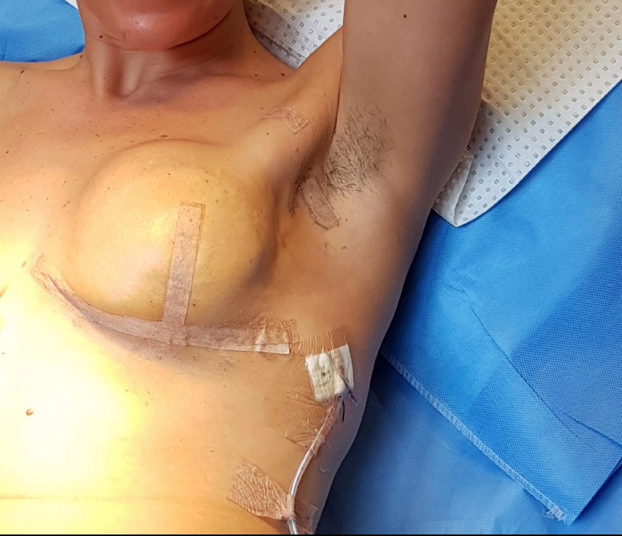 Skin sparing Mastectomy and immediate Reconstruction